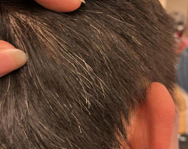 什么是營(yíng)養(yǎng)性灰白發(fā)? 什么是營(yíng)養(yǎng)性灰白發(fā)?